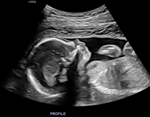 Ultrasound of baby